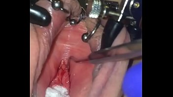 [Urethra, Female, Catheter] B Urethra Female T